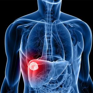 HIỆU QUẢ VÀ TÍNH AN TOÀN CỦA PEMBROLIZUMAB TRONG UNG THƯ BIỂU MÔ TẾ BÀO GAN NGUYÊN PHÁT TIẾN TRIỂN SAU ĐIỀU TRỊ VỚI SORAFENIB