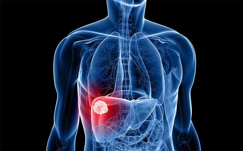 HIỆU QUẢ VÀ TÍNH AN TOÀN CỦA PEMBROLIZUMAB TRONG UNG THƯ BIỂU MÔ TẾ BÀO GAN NGUYÊN PHÁT TIẾN TRIỂN SAU ĐIỀU TRỊ VỚI SORAFENIB