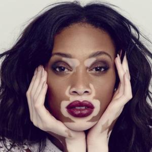 Depression, anxiety aggravated in vitiligo patients