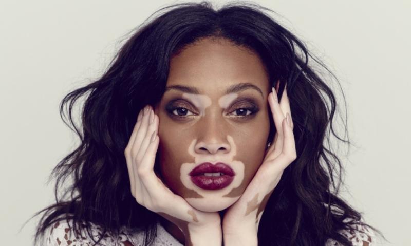 Winnie Harlow, a top model, suffers from Vitiligo. PC: The Odyssey