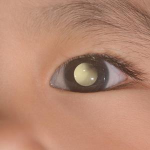 3 cycles of chemo enough for high-risk retinoblastoma in children