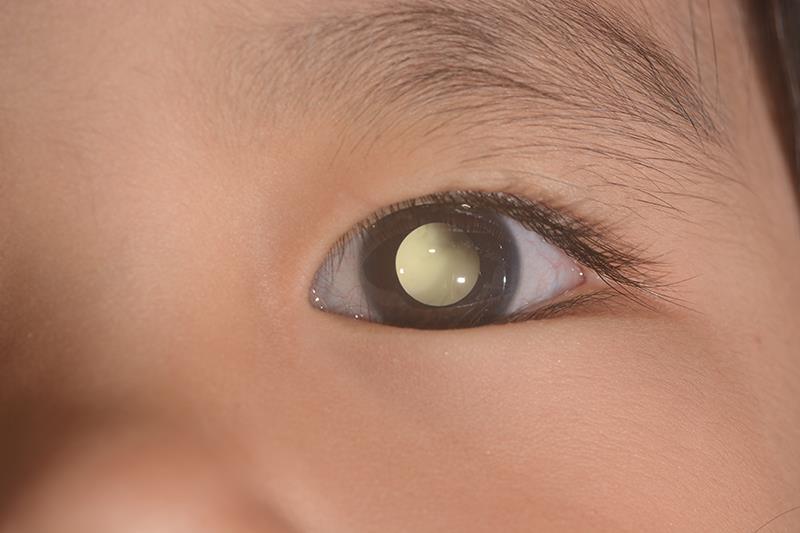 3 cycles of chemo enough for high-risk retinoblastoma in children