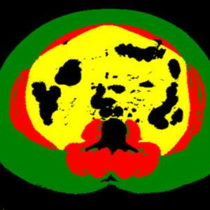 Visceral fat measurement on CT imaging may predict CV events