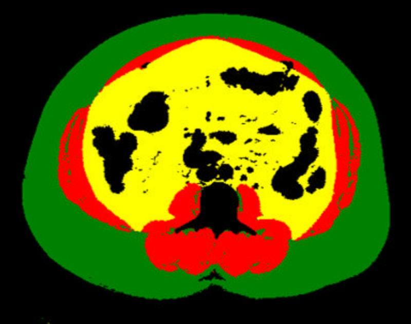 Visceral fat measurement on CT imaging may predict CV events