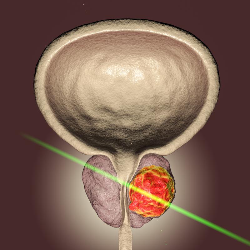 Arterial vascular events may strike men on hormone therapy for prostate cancer