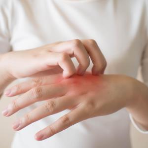 More than 90 days of oral steroids tied to higher AE risk in atopic dermatitis