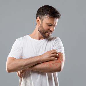 Abrocitinib trumps dupilumab for itch relief in eczema