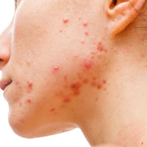 Skin disease prevalence varies with seasons