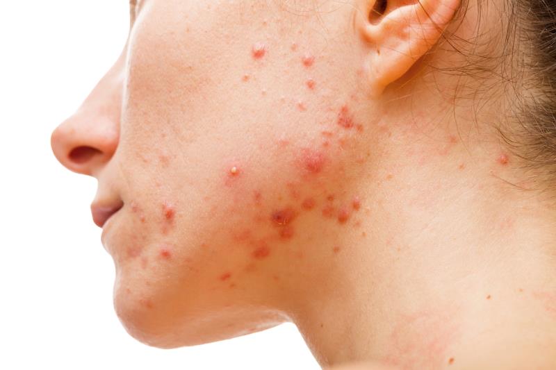 Skin disease prevalence varies with seasons