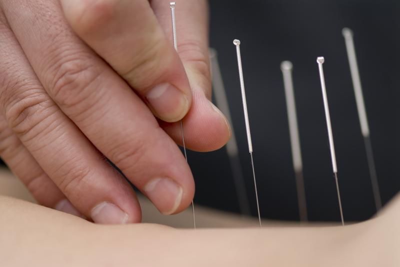 Acupuncture relieves symptoms of chronic prostatitis, pelvic pain syndrome