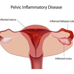 Add-on metronidazole improves outcomes in acute pelvic inflammatory disease