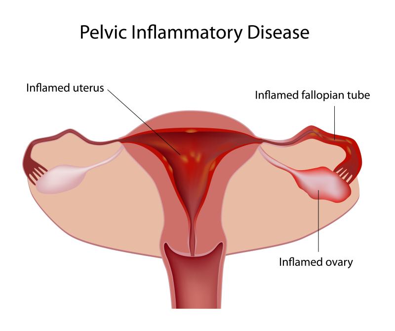 Add-on metronidazole improves outcomes in acute pelvic inflammatory disease