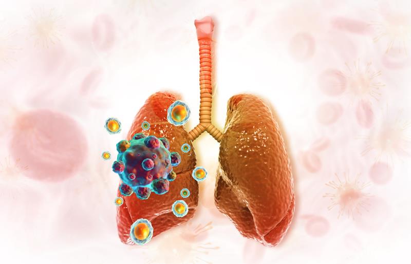 Adagrasib promising in KRASG12C -mutated NSCLC