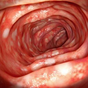 Adalimumab improves clinical remission in children with ulcerative colitis