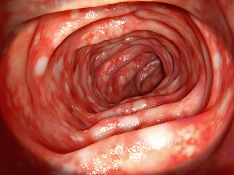 Adalimumab improves clinical remission in children with ulcerative colitis