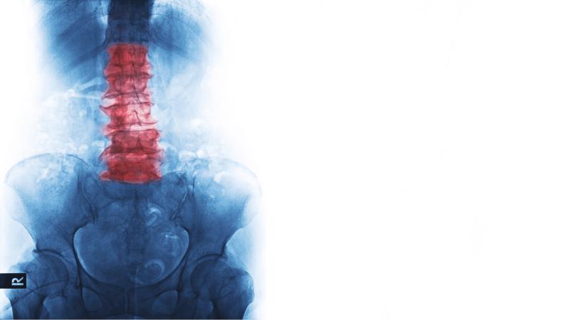 Adalimumab biosimilar may fill ‘gap’ in ankylosing spondylitis treatment