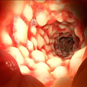 Infliximab, adalimumab both effective in biologic-naive IBD patients