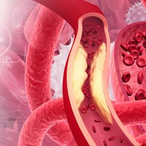 Adding alirocumab to rosuvastatin reduces coronary plaque in patients with acute MI