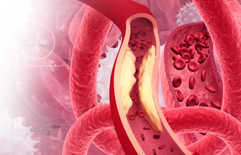 Adding alirocumab to rosuvastatin reduces coronary plaque in patients with acute MI