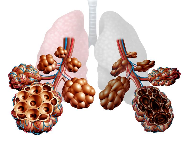 Add-on dupilumab cuts exacerbations in patients with COPD, type 2 inflammation