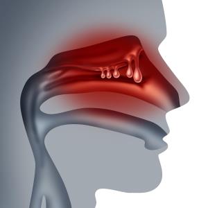 Add-on mepolizumab reduces nasal polyp size, obstruction in adults with CRSwNP