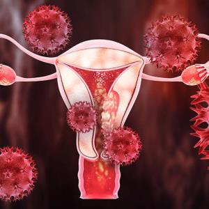 Add-on niraparib maintenance confers PFS benefit in endometrial cancer