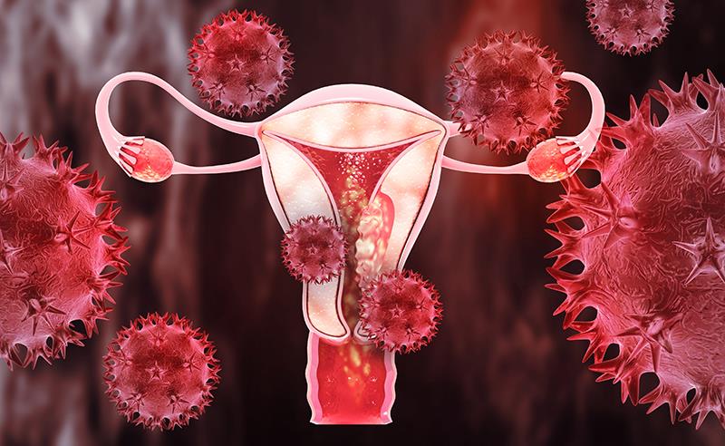 Add-on niraparib maintenance confers PFS benefit in endometrial cancer
