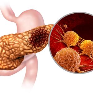 Adjuvant FOLFIRINOX ups survival in pancreatic cancer