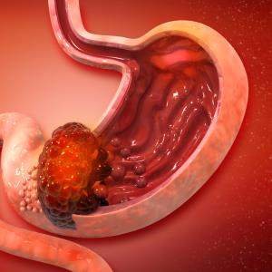 Compromised nutritional, immunological status ups infection risk after gastric cancer surgery