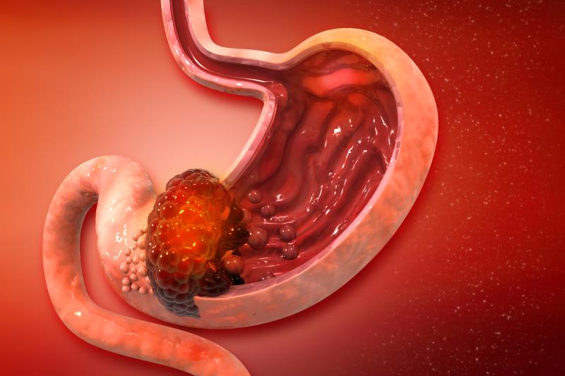 Compromised nutritional, immunological status ups infection risk after gastric cancer surgery