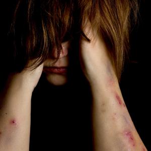 The peer factor: Nonsuicidal self-harm may spur copycats among teens