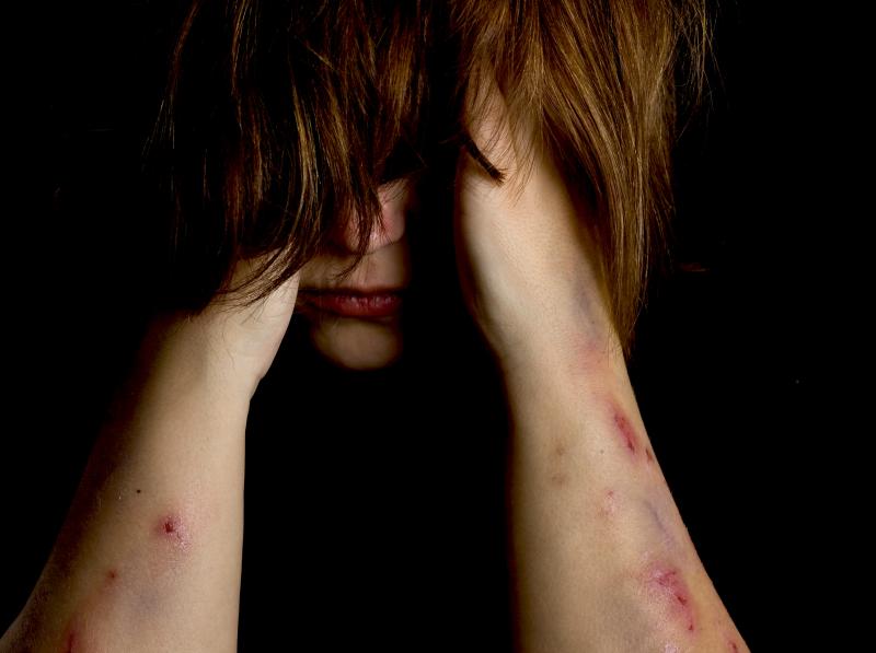 The peer factor: Nonsuicidal self-harm may spur copycats among teens