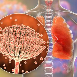 Advancing management of invasive mould disease: Expert insights and practical case study