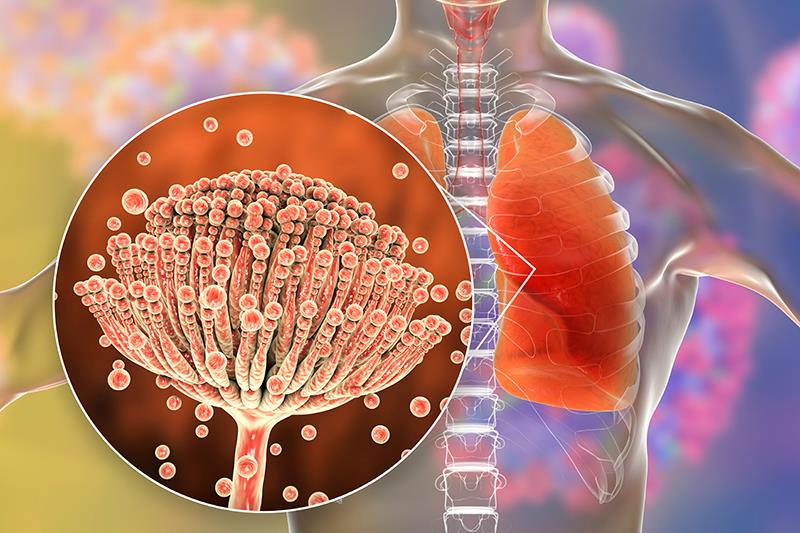 Advancing management of invasive mould disease: Expert insights and practical case study