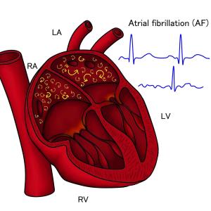 Apixaban may be the DOAC of choice for AF patients at risk for GI bleeding