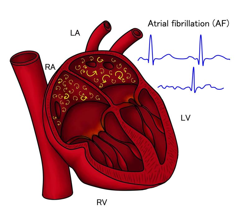 Apixaban may be the DOAC of choice for AF patients at risk for GI bleeding