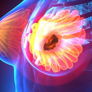 Cutting first-day dexamethasone dose not recommended for breast cancer patients on anthracycline