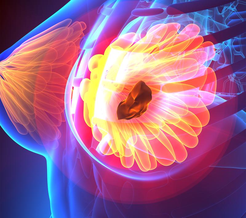 Cutting first-day dexamethasone dose not recommended for breast cancer patients on anthracycline