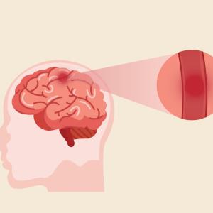 Early addition of cerebrolysin to reperfusion therapy reduces haemorrhagic transformation after ischaemic stroke