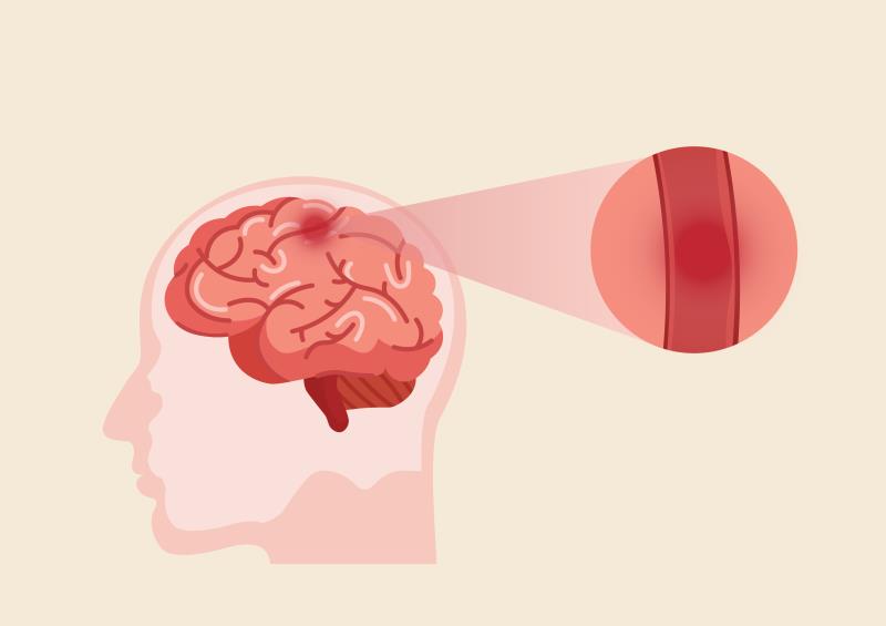 Early addition of cerebrolysin to reperfusion therapy reduces haemorrhagic transformation after ischaemic stroke