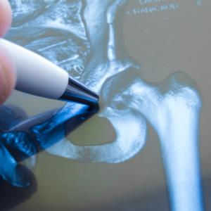 Denosumab increases BMD, cuts fracture risk in osteoporosis patients with diabetes