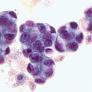 Adjuvant alectinib boosts DFS in early stage, resected ALK+ NSCLC