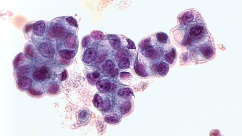 Adjuvant alectinib boosts DFS in early stage, resected ALK+ NSCLC