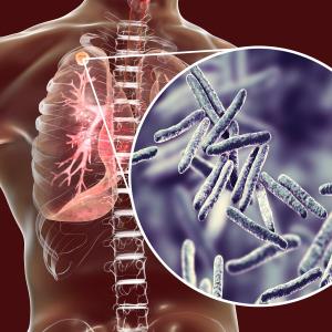 Triplet regimen yields 90 percent cure rate for XDR/MDR TB in latest study