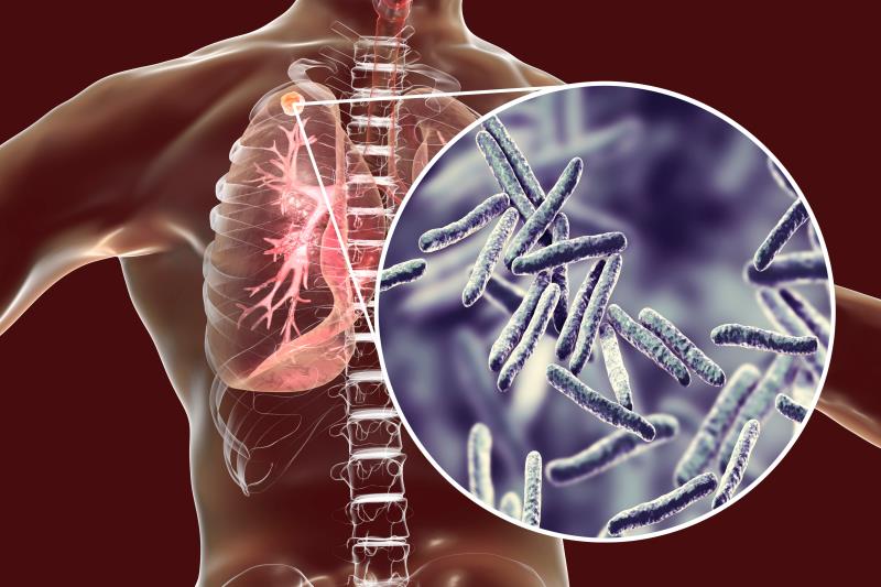 All-oral triplet regimen yields 90 percent cure rate for XDR/MDR TB in latest study