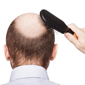 Transdermal microneedle less painful vs intralesional injection in AA