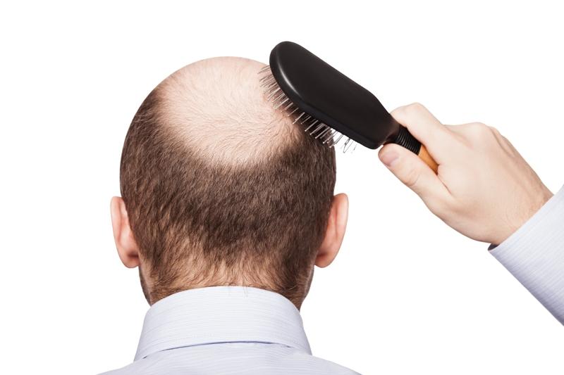 Transdermal microneedle delivery less painful than intralesional injection in AA treatment