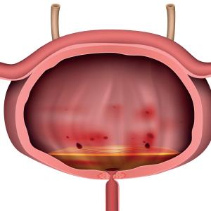 Methenamine hippurate as good as antibiotic prophylaxis for recurrent UTI