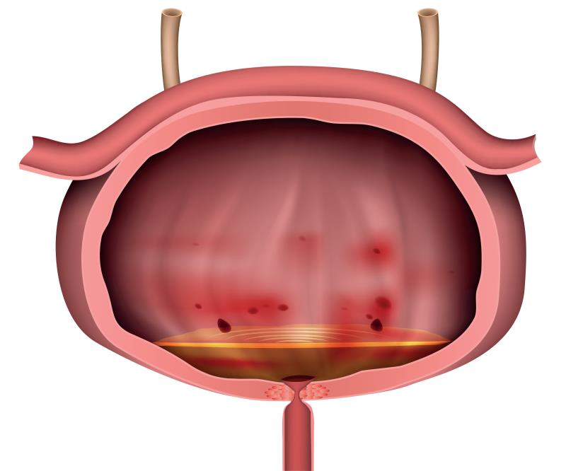 Methenamine hippurate as good as antibiotic prophylaxis for recurrent UTI