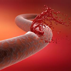 Bleeding risk high for percutaneous coronary intervention patients